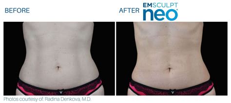 I Tried Emsculpt Neo — Here’s My Before And After.